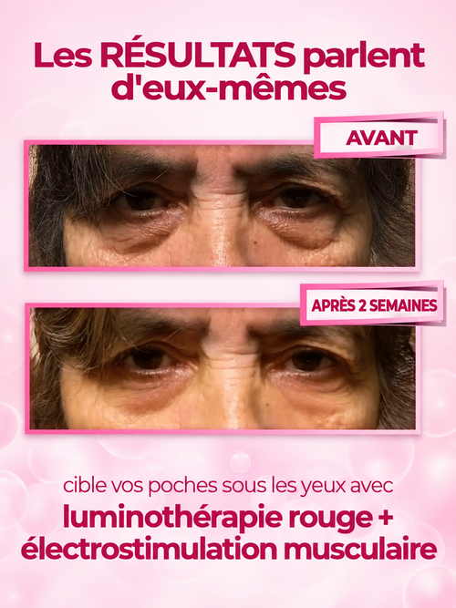 GlowEyes 2-en-1 Lumière rouge + Micro-courant pour atténuer cernes et poches